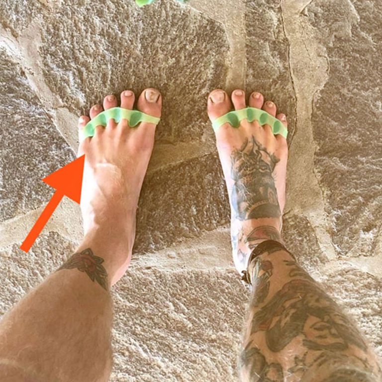 Life Goals “Bunions” and toe spacers How an orthotic can help with